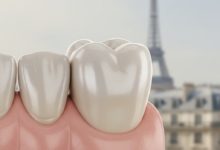 Close-up, photorealistic image of a natural-looking dental implant crown integrated into a clean gum line, with a softly blurred background showing a faint silhouette of the Eiffel Tower in Paris, France.